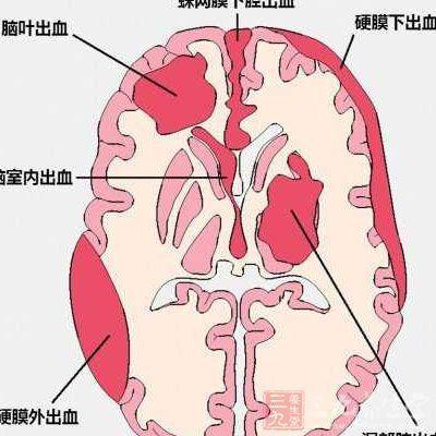 脑出血.png